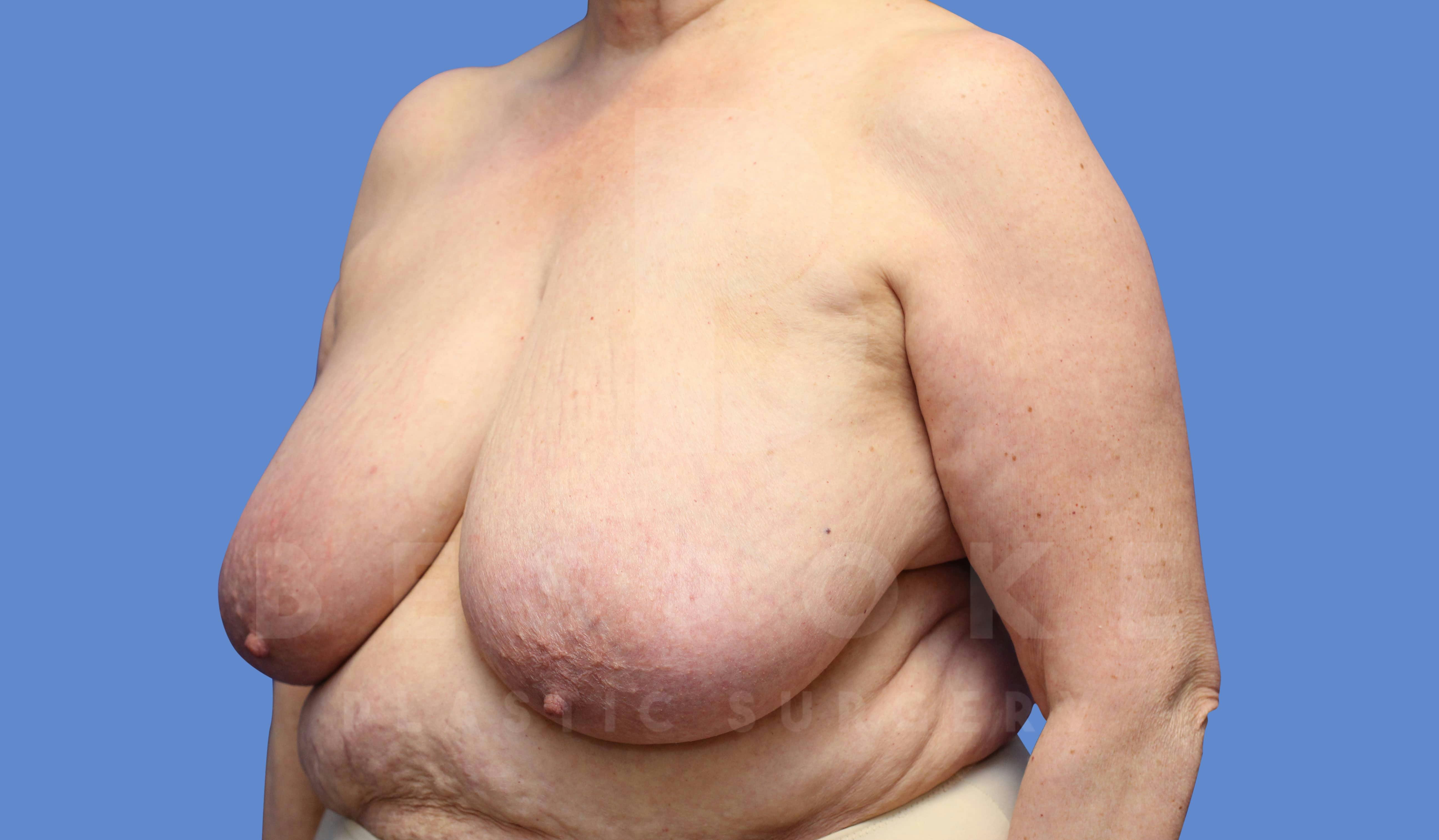 Breast Reduction Before & After Gallery - Patient 143802358 - Image 1