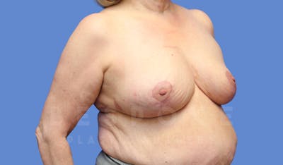 Breast Reduction Before & After Gallery - Patient 143802358 - Image 4