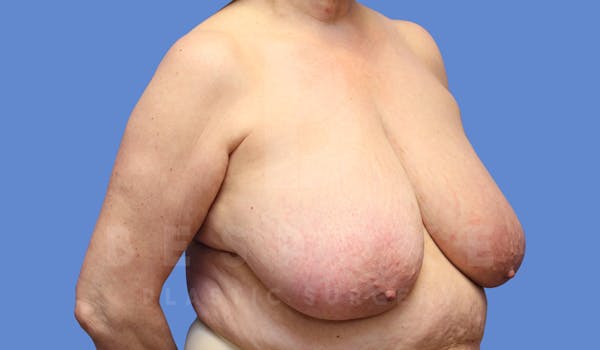 Breast Reduction Before & After Gallery - Patient 143802358 - Image 3