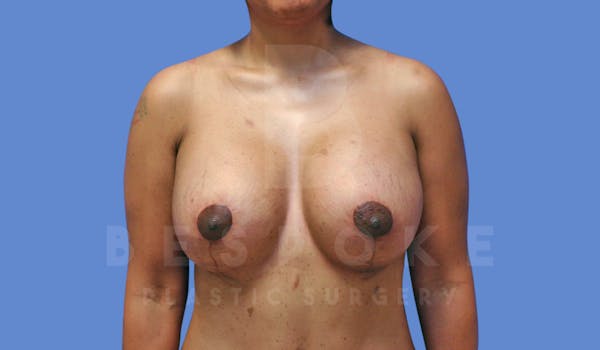 Breast Revision Surgery Before & After Gallery - Patient 143802368 - Image 2