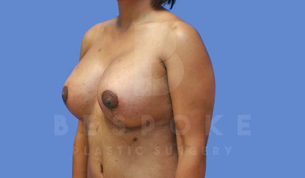 Breast Revision Surgery Before & After Gallery - Patient 143802368 - Image 4