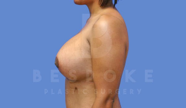 Breast Revision Surgery Before & After Gallery - Patient 143802368 - Image 6