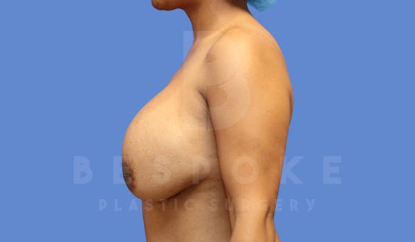 Breast Revision Surgery Before & After Gallery - Patient 143802368 - Image 5