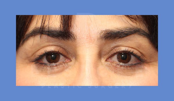 Eyelid Surgery Before & After Gallery - Patient 143803923 - Image 2
