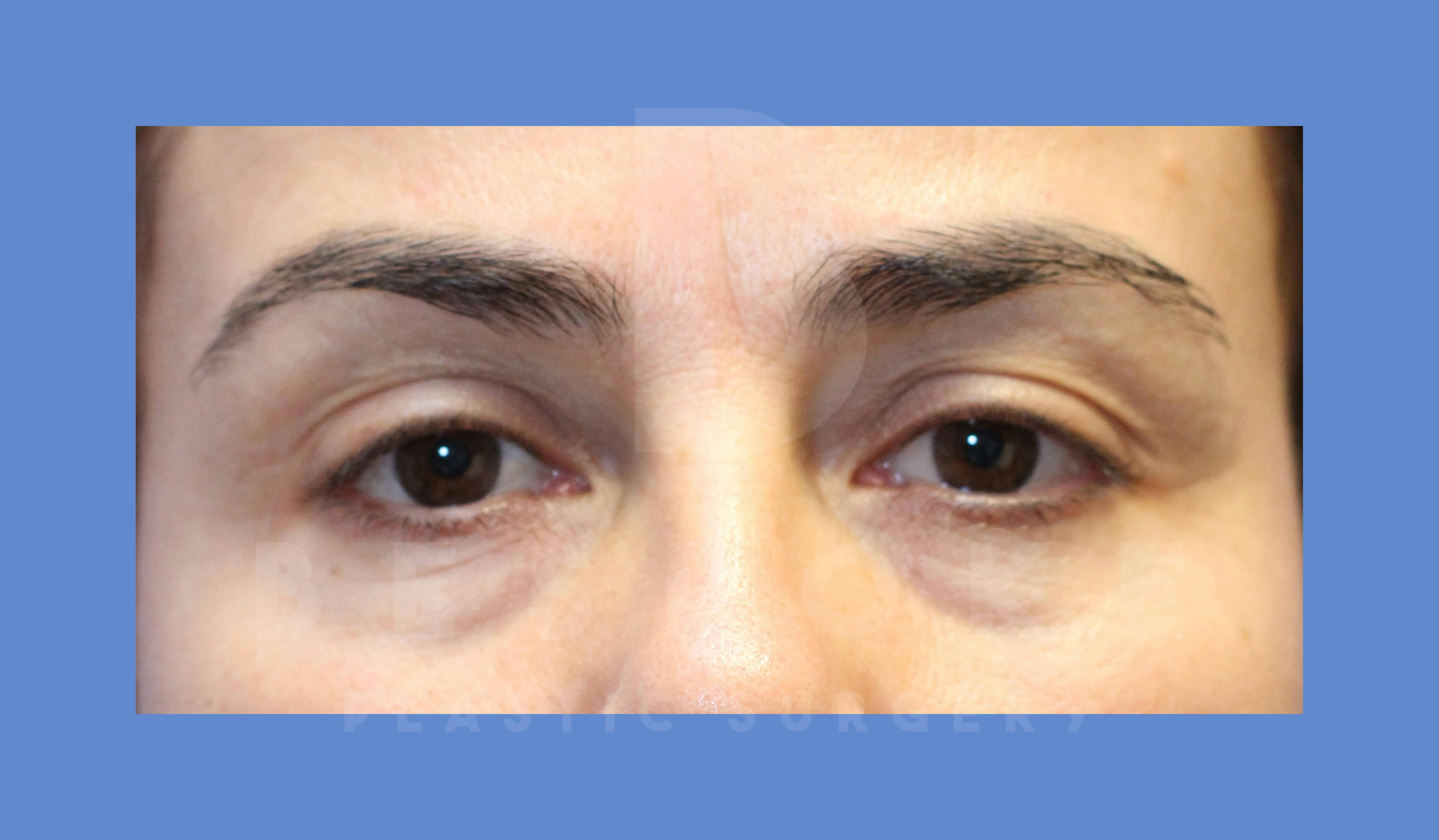 Eyelid Surgery Before & After Gallery - Patient 143803923 - Image 1