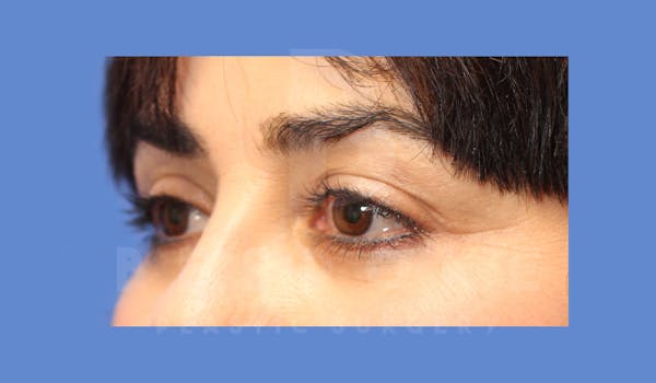Eyelid Surgery Before & After Gallery - Patient 143803923 - Image 4