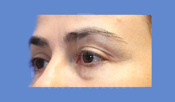 Eyelid Surgery Before & After Gallery - Patient 143803923 - Image 3