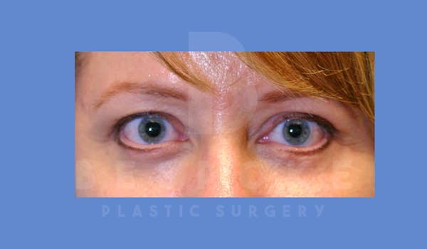 Eyelid Surgery Before & After Gallery - Patient 143803924 - Image 2