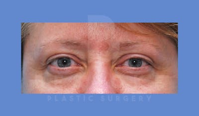 Eyelid Surgery Before & After Gallery - Patient 143803924 - Image 1