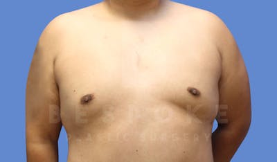 Gynecomastia Before & After Gallery - Patient 143803936 - Image 2