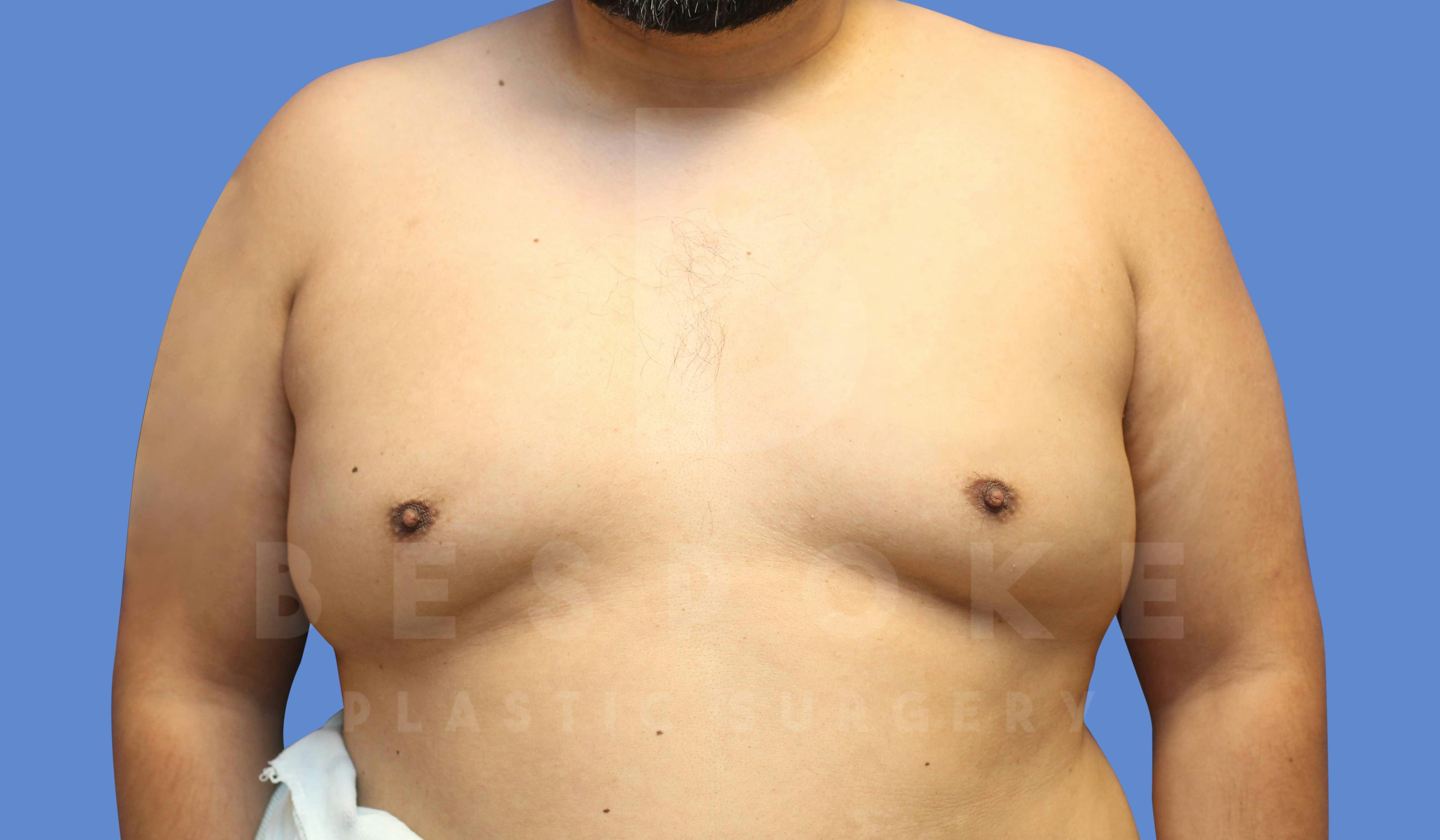 Gynecomastia Before & After Gallery - Patient 143803936 - Image 1