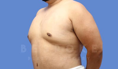 Gynecomastia Before & After Gallery - Patient 143803936 - Image 4