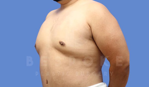 Gynecomastia Before & After Gallery - Patient 143803936 - Image 4