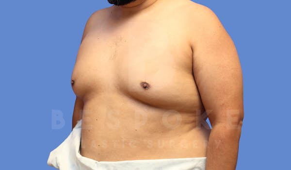 Gynecomastia Before & After Gallery - Patient 143803936 - Image 3