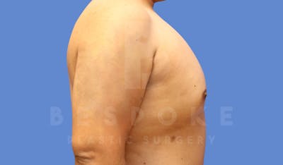 Gynecomastia Before & After Gallery - Patient 143803936 - Image 6