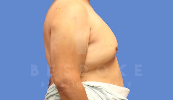 Gynecomastia Before & After Gallery - Patient 143803936 - Image 5
