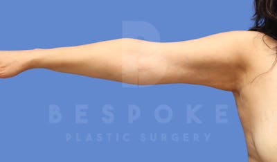 Liposuction Before & After Gallery - Patient 143803978 - Image 2