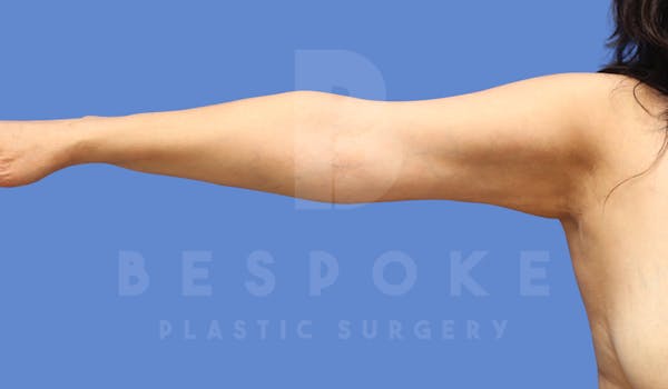 Liposuction Before & After Gallery - Patient 143803978 - Image 2