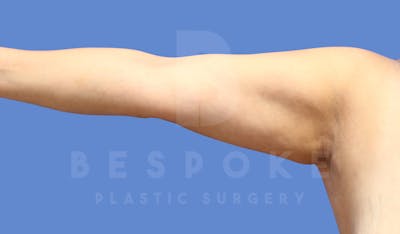Liposuction Before & After Gallery - Patient 143803978 - Image 1