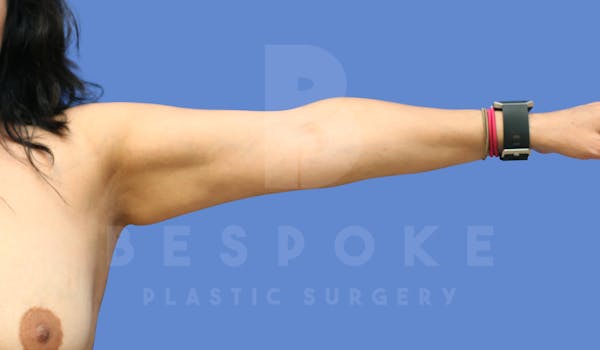 Liposuction Before & After Gallery - Patient 143803978 - Image 4
