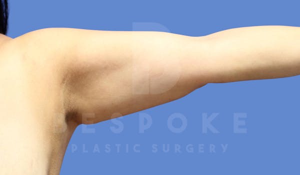 Liposuction Before & After Gallery - Patient 143803978 - Image 3