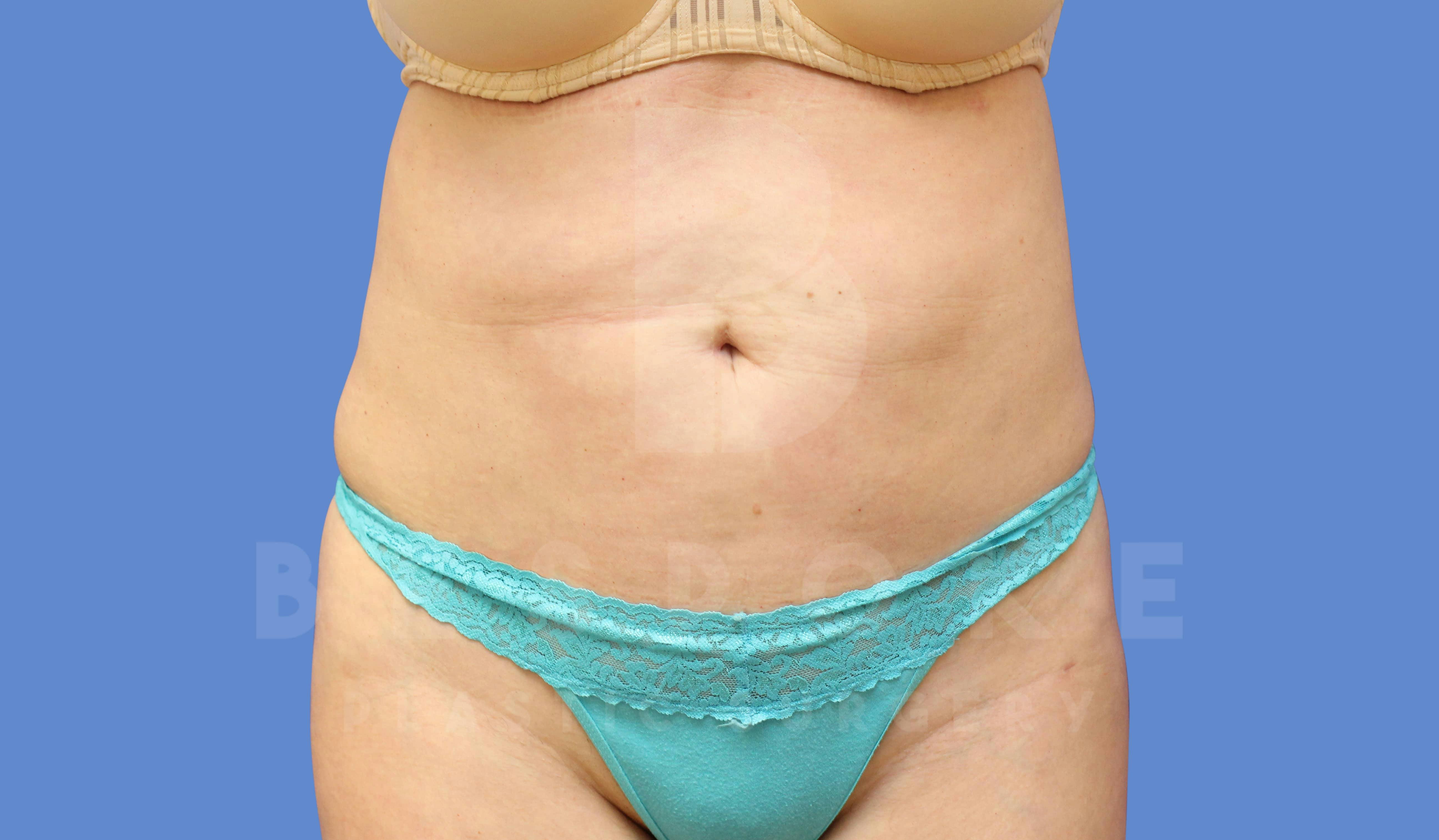 Liposuction Before & After Gallery - Patient 143803977 - Image 2