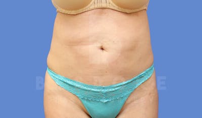 Liposuction Before & After Gallery - Patient 143803977 - Image 2