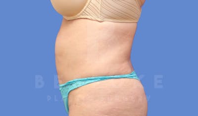 Liposuction Before & After Gallery - Patient 143803977 - Image 4