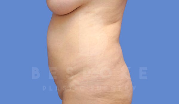 Liposuction Before & After Gallery - Patient 143803977 - Image 3