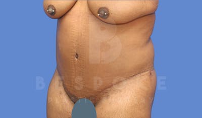 Tummy Tuck Before & After Gallery - Patient 143803994 - Image 2