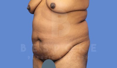 Tummy Tuck Before & After Gallery - Patient 143803994 - Image 1
