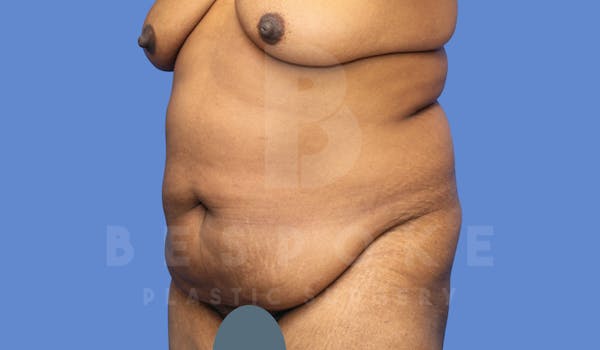 Tummy Tuck Before & After Gallery - Patient 143803994 - Image 1
