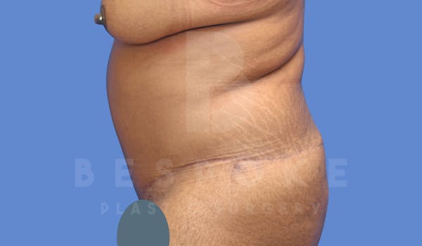 Tummy Tuck Before & After Gallery - Patient 143803994 - Image 4