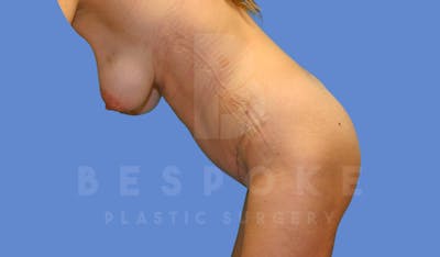 Tummy Tuck Before & After Gallery - Patient 143803993 - Image 4