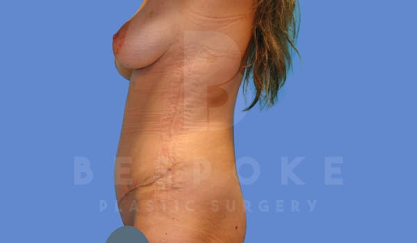 Tummy Tuck Before & After Gallery - Patient 143803993 - Image 6