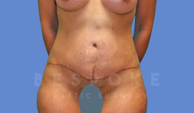 Tummy Tuck Before & After Gallery - Patient 143824397 - Image 2