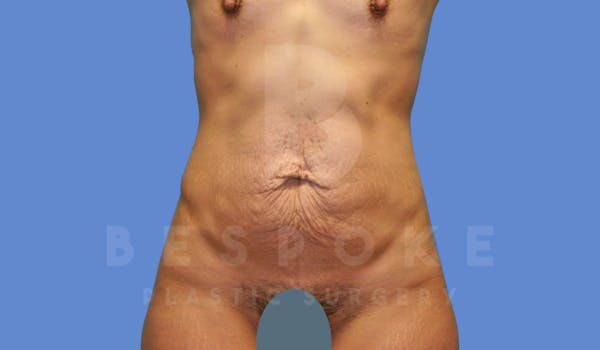 Tummy Tuck Before & After Gallery - Patient 143824397 - Image 1