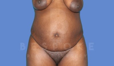 Tummy Tuck Before & After Gallery - Patient 143824398 - Image 1