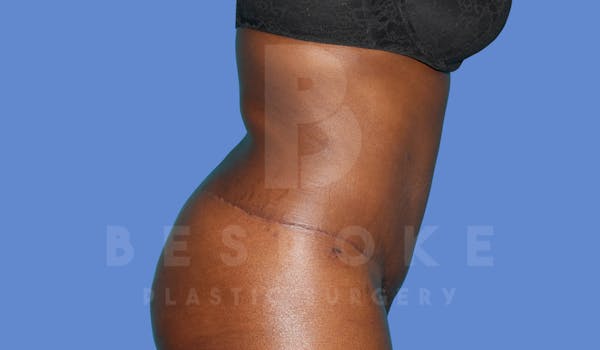 Tummy Tuck Before & After Gallery - Patient 143824398 - Image 6