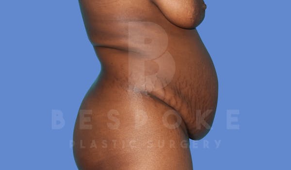 Tummy Tuck Before & After Gallery - Patient 143824398 - Image 5