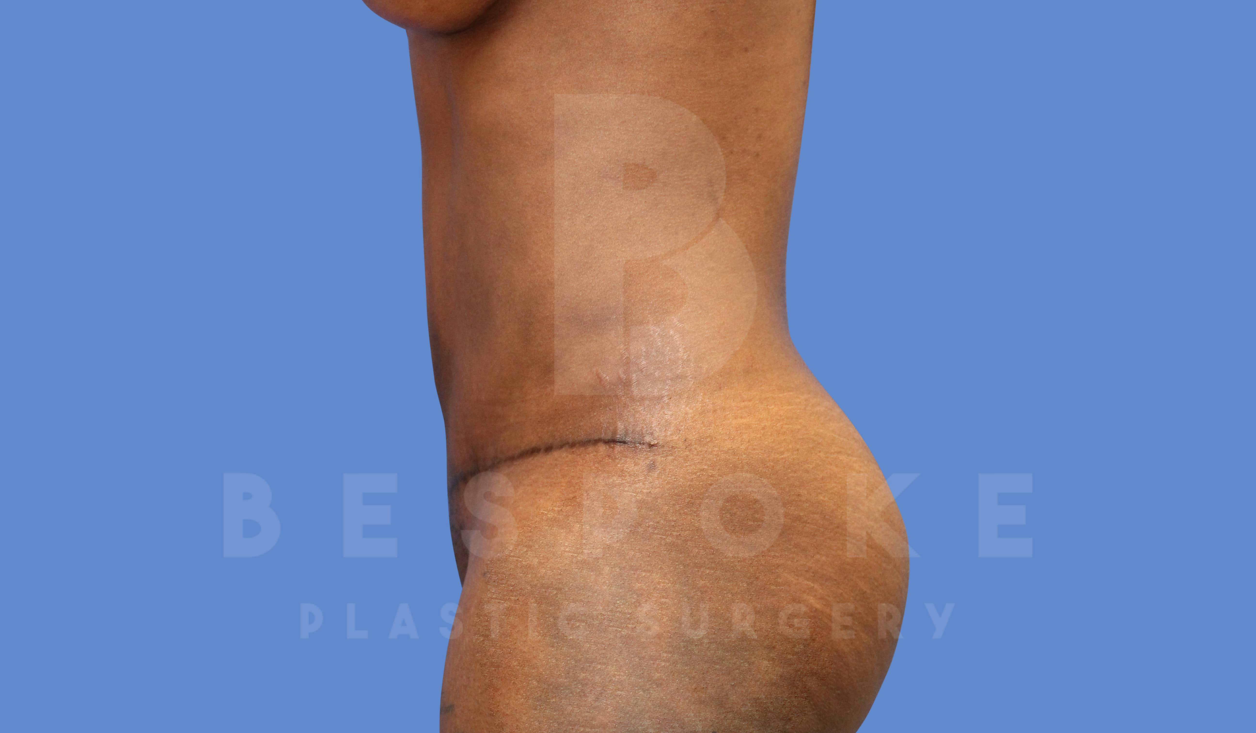 Tummy Tuck Before & After Gallery - Patient 143824399 - Image 2