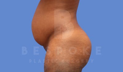 Tummy Tuck Before & After Gallery - Patient 143824399 - Image 1