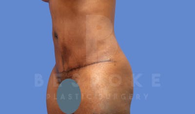 Tummy Tuck Before & After Gallery - Patient 143824399 - Image 4