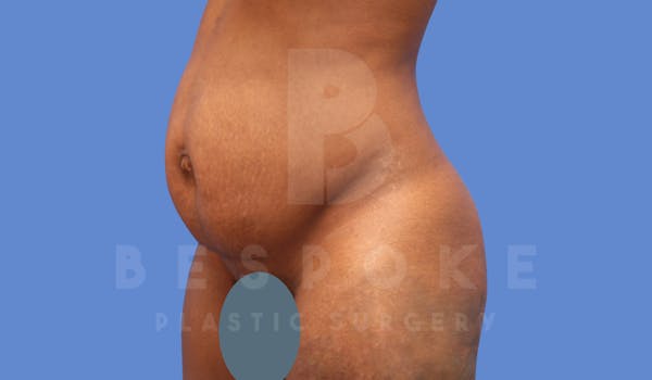 Tummy Tuck Before & After Gallery - Patient 143824399 - Image 3
