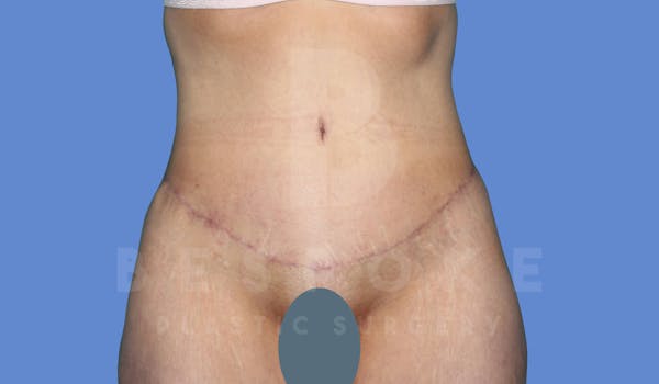 Tummy Tuck Before & After Gallery - Patient 143824400 - Image 2