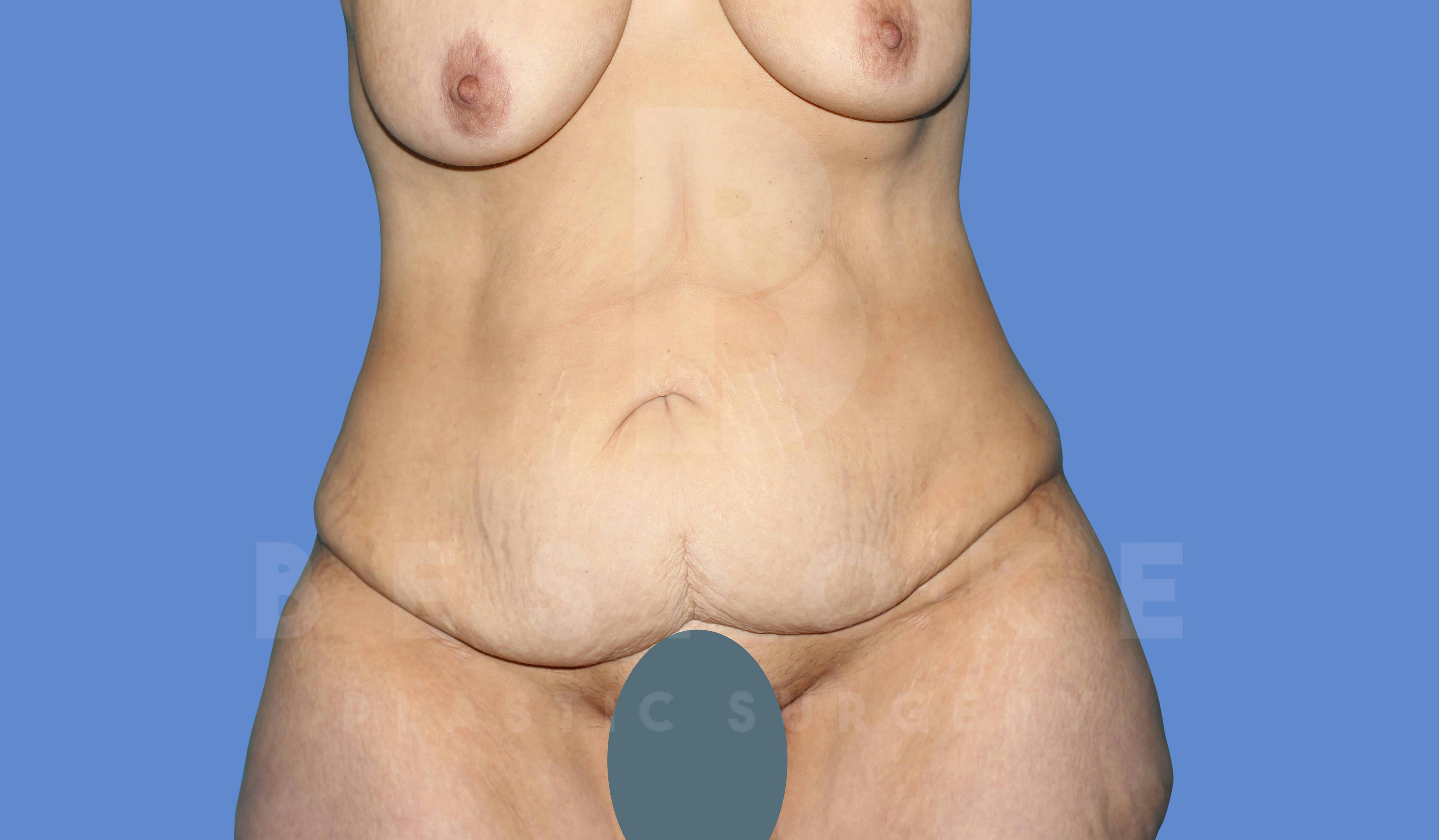 Tummy Tuck Before & After Gallery - Patient 143824400 - Image 1