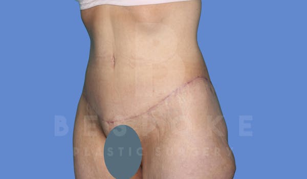 Tummy Tuck Before & After Gallery - Patient 143824400 - Image 4