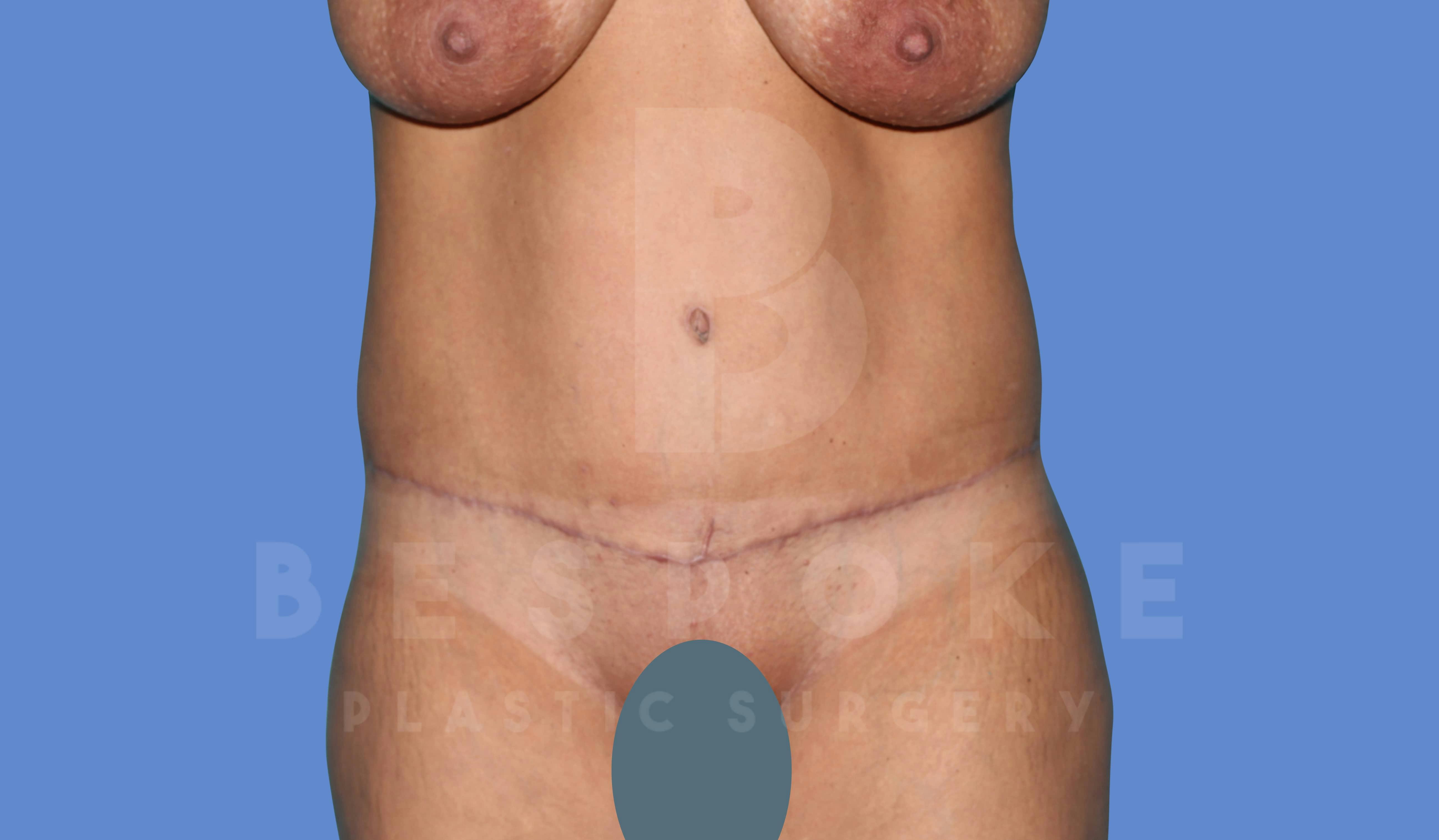 Tummy Tuck Before & After Gallery - Patient 143824401 - Image 2