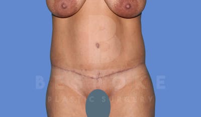Tummy Tuck Before & After Gallery - Patient 143824401 - Image 2