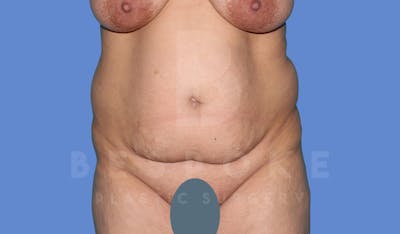 Tummy Tuck Before & After Gallery - Patient 143824401 - Image 1